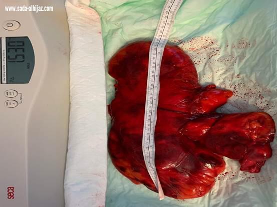 استئصال ورم بوزن ( كيلو و نصف ) من صدر رجل أربعيني بمستشفى شرق جدة
