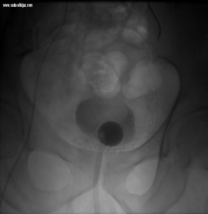 خدمة طبية جديدة لعلاج تضخم البروستات بمستشفى النور التخصصي