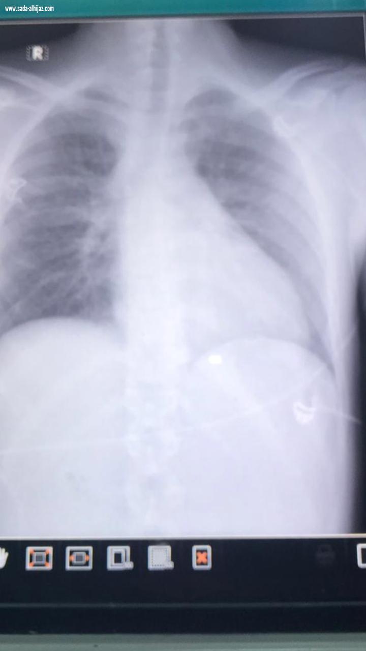 عملية قلب مفتوح عاجلة لشاب أصيب برصاصة بمستشفى الملك فهد بجدة