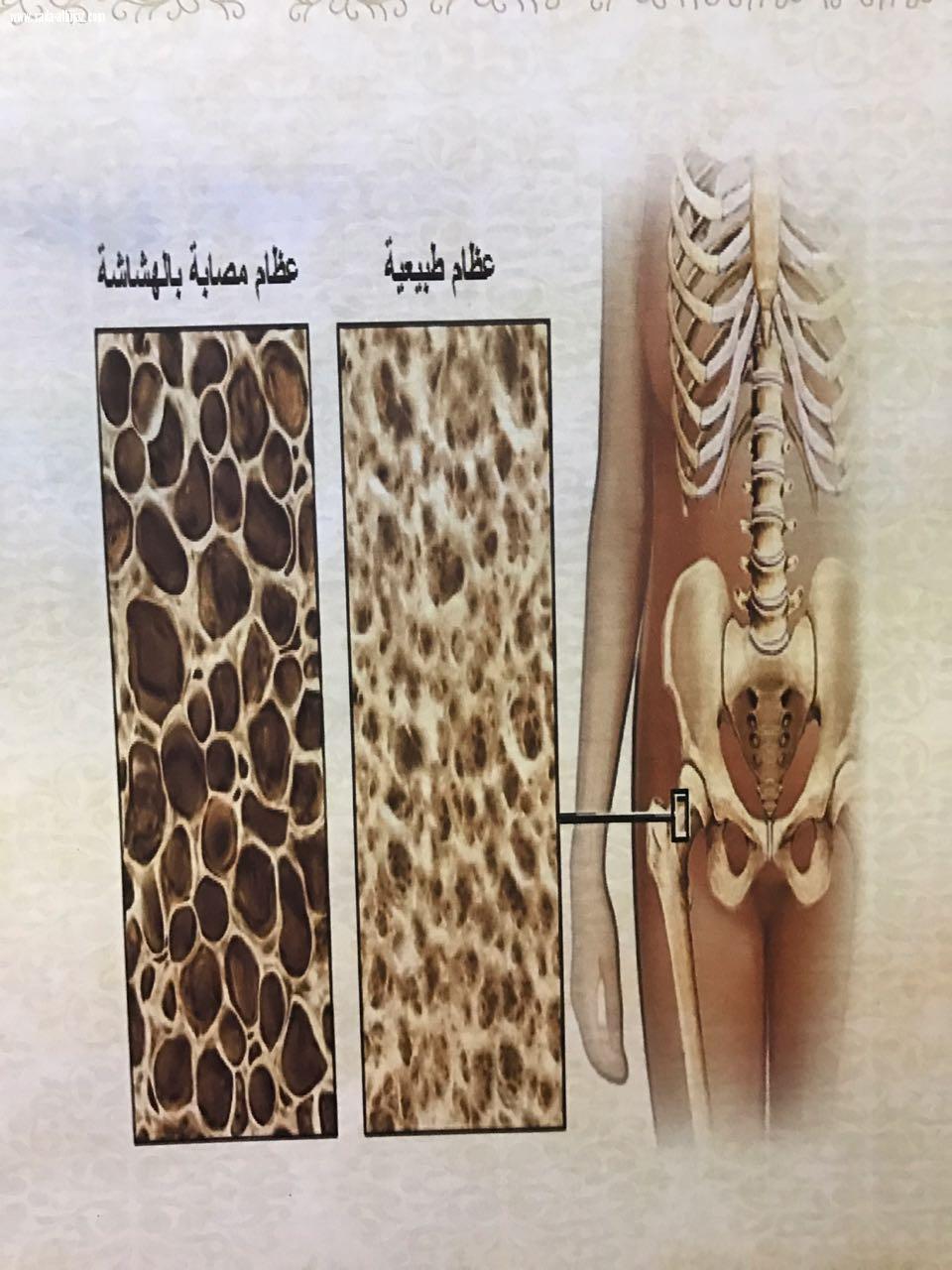 اليوم العالمي لهشاشه العظام بمدرسه الحقله ب/م