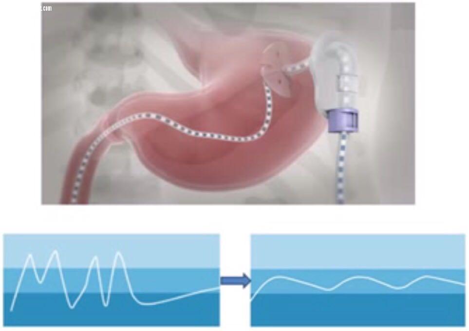 مستشفى الملك فهد بالمدينه المنوره يعيد لمريض ستيني النطق والحركه