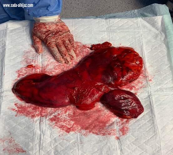 استئصال ورم بوزن ( كيلو و نصف ) من صدر رجل أربعيني بمستشفى شرق جدة