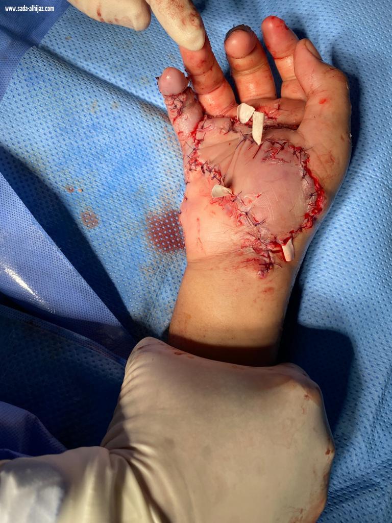 عملية ترميم لإعادة  يد  متهتكة لمصاب في حادث مروري بمستشفى المؤسس بجدة