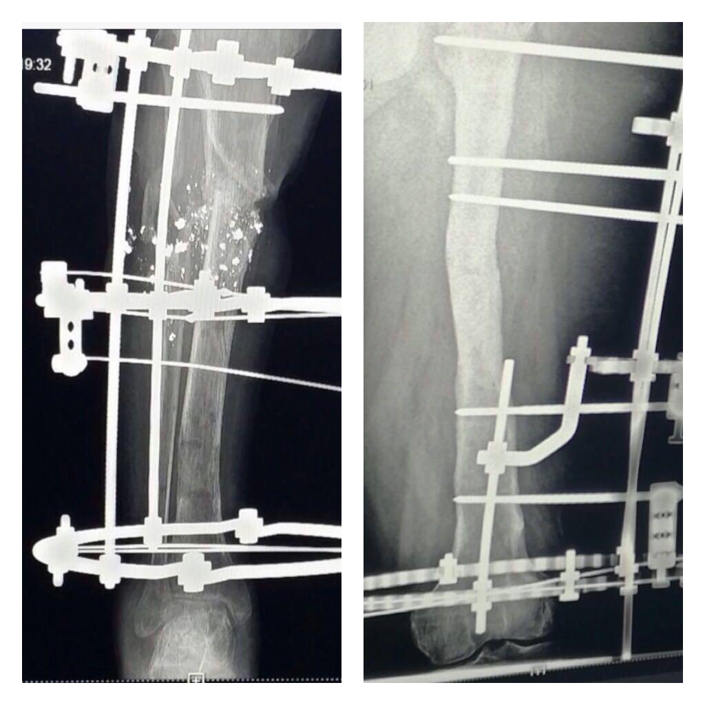 عمليتان نوعيتان لتعويض العظام المفقودة لشابين في جازان