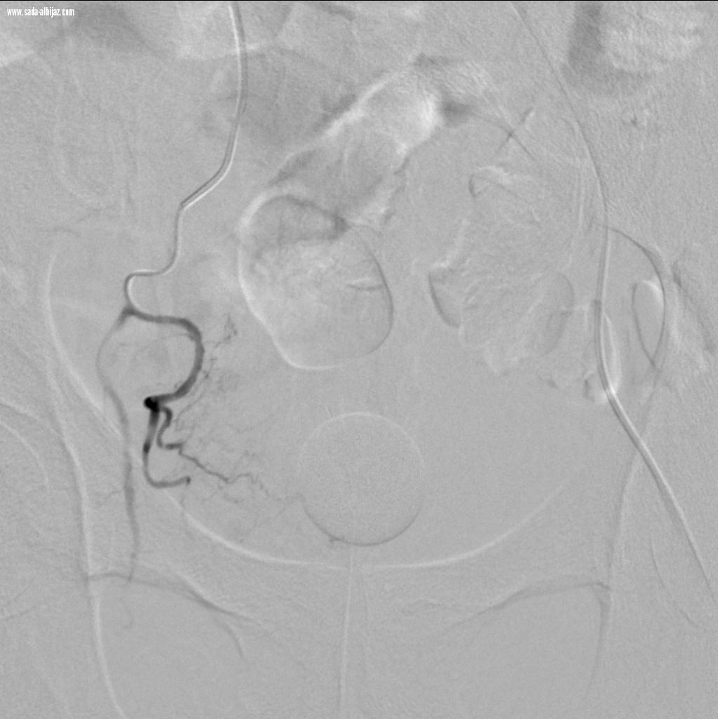 خدمة طبية جديدة لعلاج تضخم البروستات بمستشفى النور التخصصي