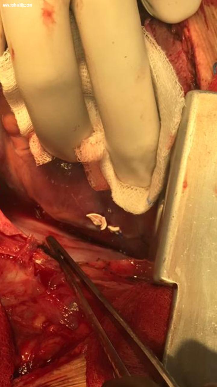 عملية قلب مفتوح عاجلة لشاب أصيب برصاصة بمستشفى الملك فهد بجدة