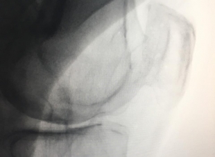 التردد الحراري علاج بدون جراحة لخشونة الركبة بمستشفى الملك فهد بجدة