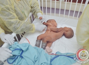 انفاذا لتوجيهات خادم الحرمين الشريفين حفظه الله  وصول التوأم السيامي التنزاني انيسيا وملينيس لمدينة الملك عبدالعزيز الطبية بالرياض