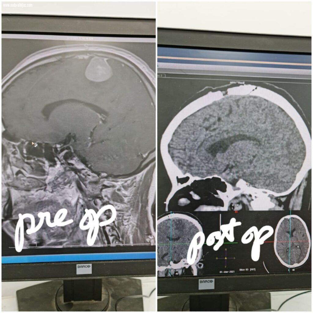 إنهاء معاناة مريضة من ورم في في الدماغ بمستشفى الملك خالد بتبوك
