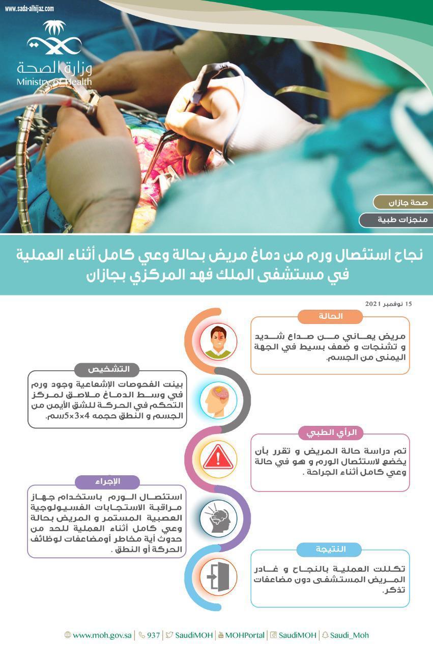 نجاح إستئصال ورم من دماغ مريض بحالة وعي كامل أثناء العملية في مستشفى الملك فهد المركزي بجازان