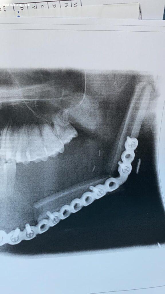 استئصال ورم وإعادة ترميم فك في ثلاث عمليات بمستشفى الملك فهد بالمدينة المنورة