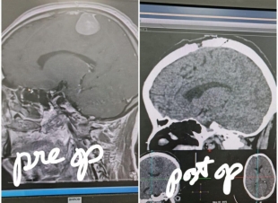 إنهاء معاناة مريضة من ورم في في الدماغ بمستشفى الملك خالد بتبوك
