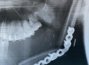 استئصال ورم وإعادة ترميم فك في ثلاث عمليات بمستشفى الملك فهد بالمدينة المنورة