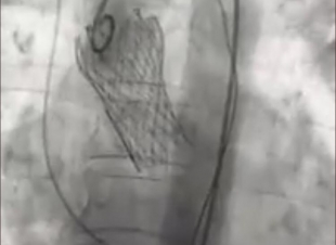 مركز أمراض وجراحة القلب في القريات ينجح في زراعة صمام أورطي لمريض